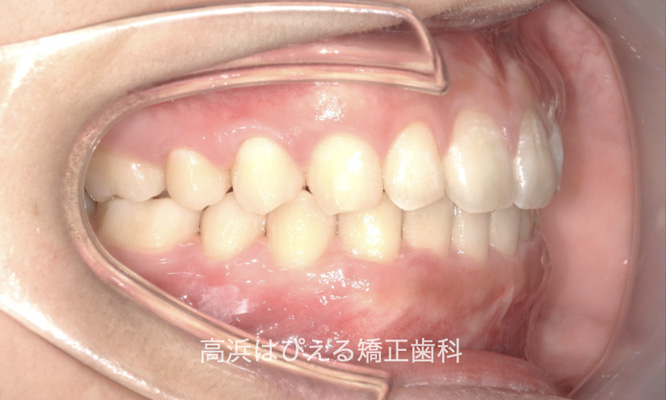 出っ歯（上顎前突）1