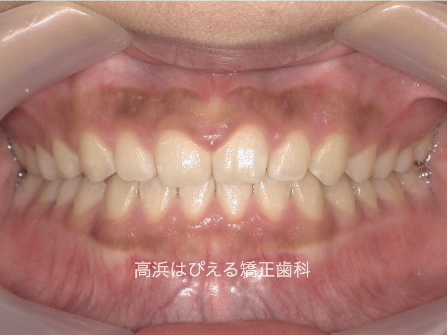 出っ歯（上顎前突）1