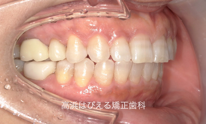 出っ歯（上顎前突）2