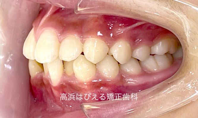 歯でこぼこ（叢生）1