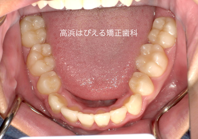 歯でこぼこ（叢生）1