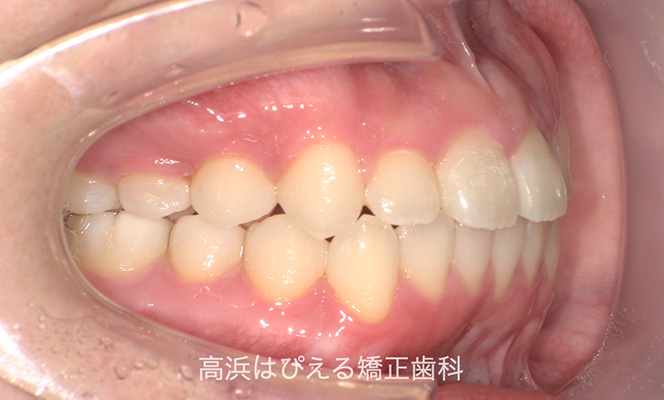 出っ歯（上顎前突）2