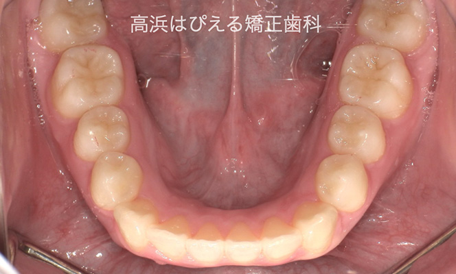 出っ歯（上顎前突）1