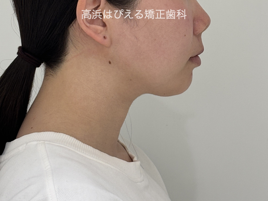 出っ歯（上顎前突）1