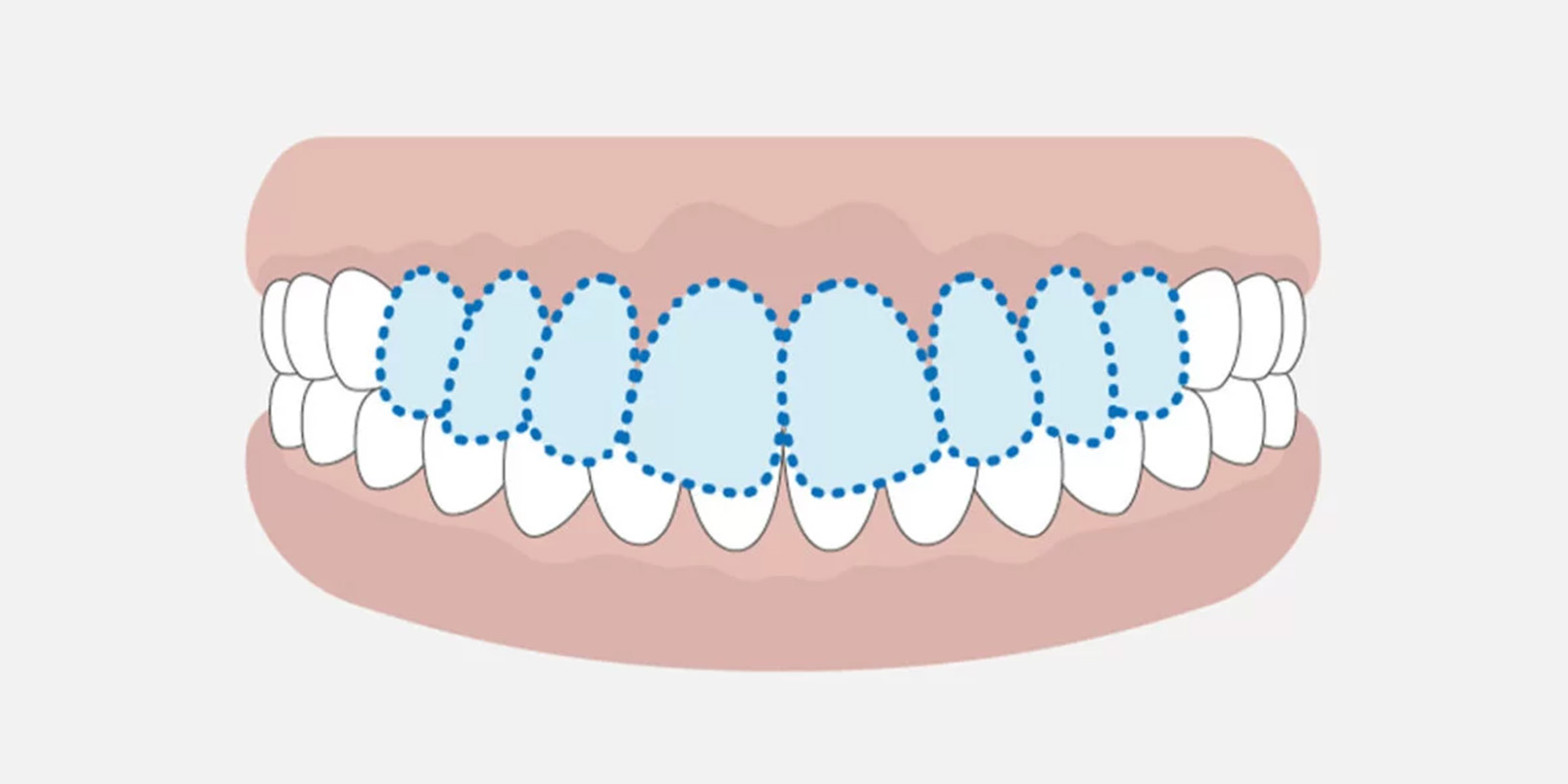 (深い噛み合わせ)